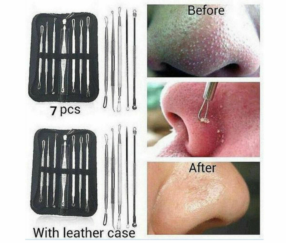 Pimple acne Black head Remover Kit