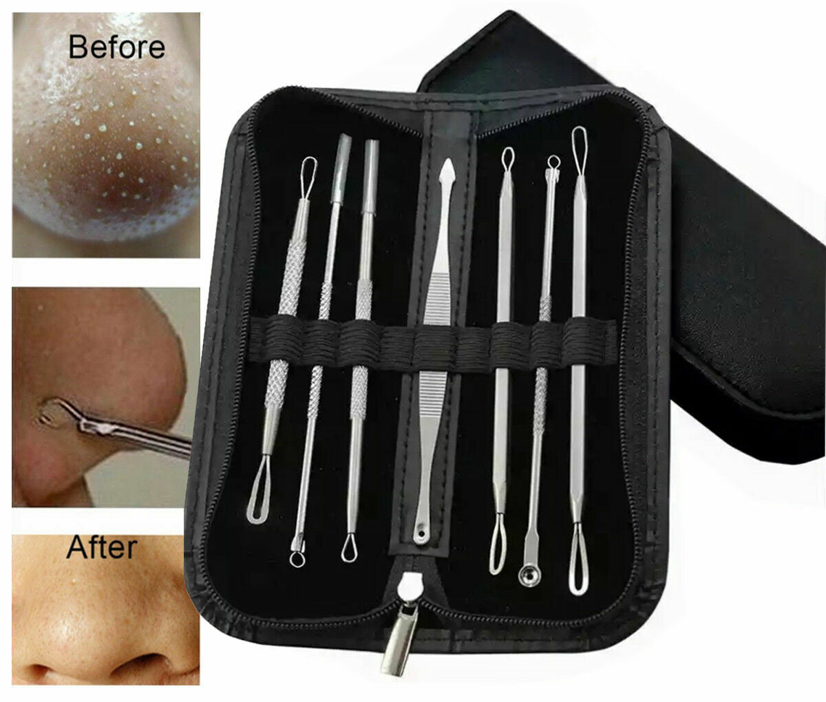 PIMPLE POPPER TOOL BLACKHEAD REMOVER KIT SPOT ACNE COMEDONE EXTRACTOR COMEDON