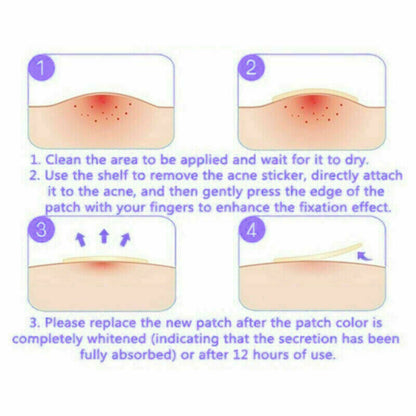 48 PCS Skin Tag & Acne Patch